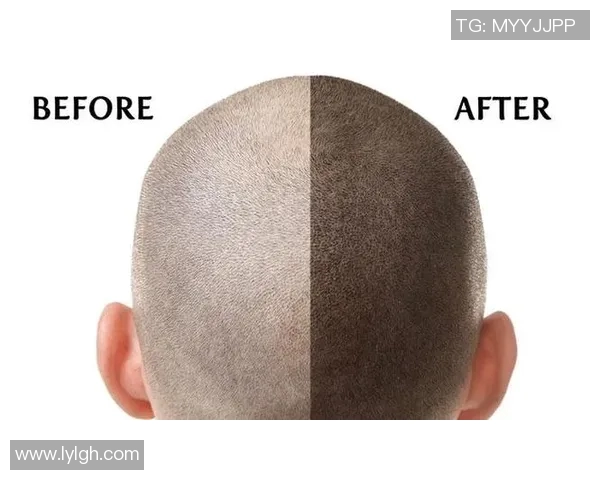 脱发困扰下的足球明星们如何应对发际线后退的烦恼与挑战